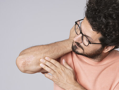 Man looking at skin rash on arm